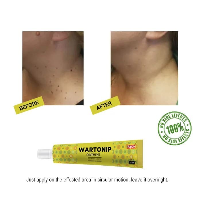 Wartonip Ointment (25gm) 3